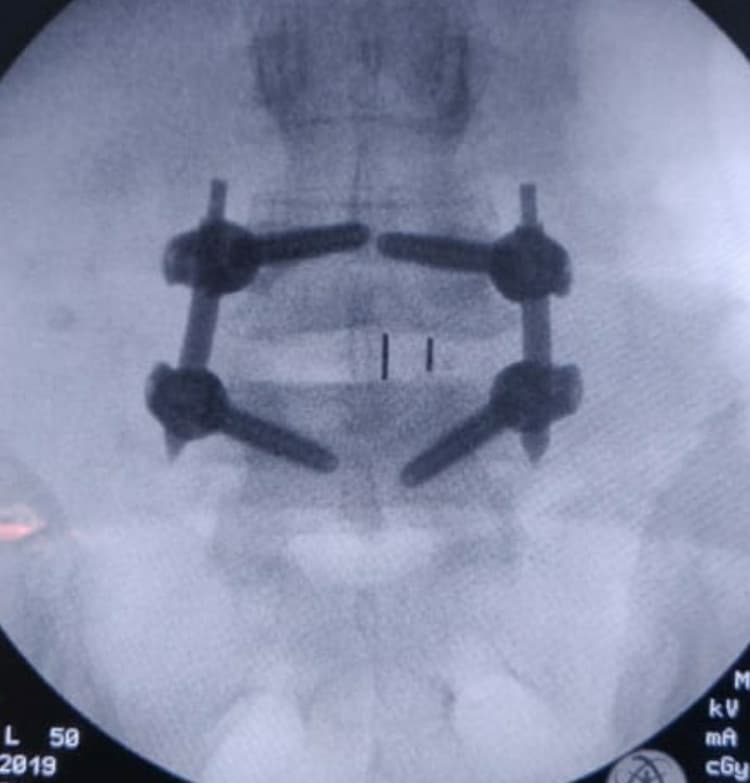 Postoperative Image 1